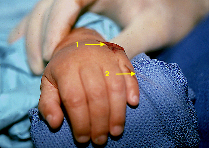 Metacarpal Synostosis Hand Surgery Resource 3498